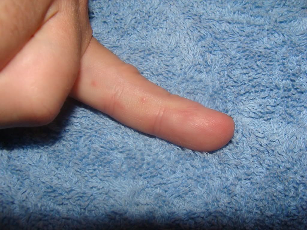 Gulf War Rash Help Requested Survival Forum Off Grid SHTF Prepper