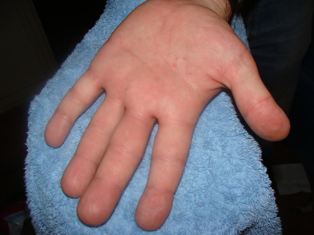 Gulf War Rash Help Requested Survival Forum Off Grid SHTF Prepper